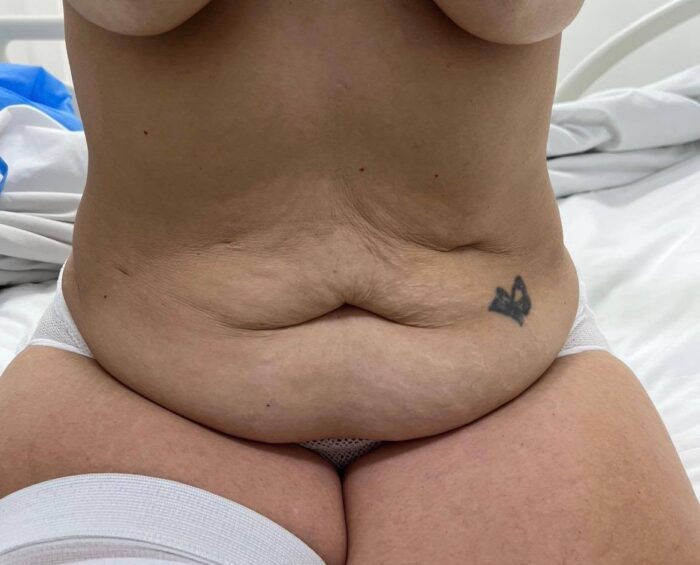 Resultado de Lipoabdominoplastia — Cony